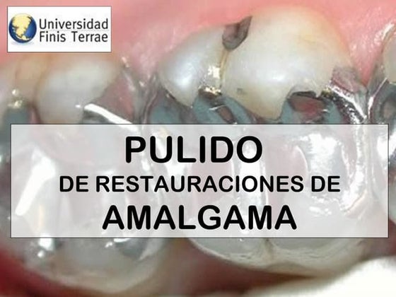 Pulido de Restauraciones de Amalgama