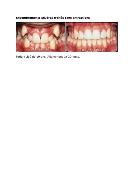 Encombrements sévères traités sans extractions