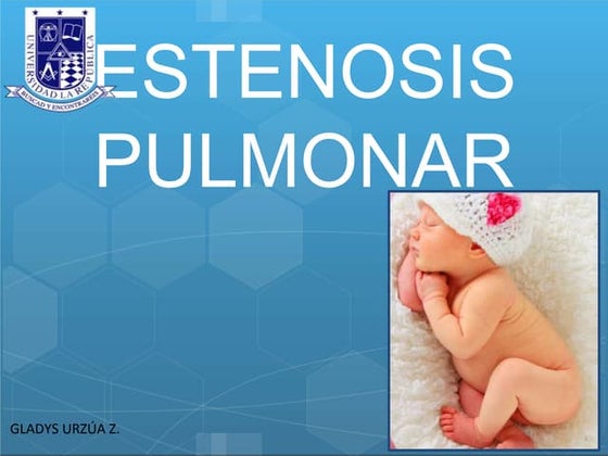 Estenosis pulmonar