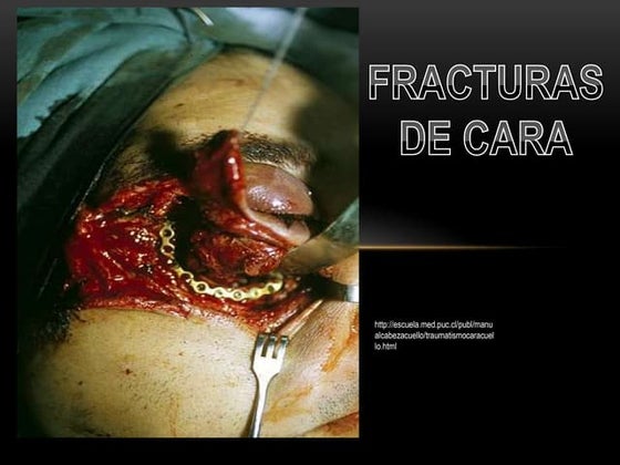 Fracturas de cara