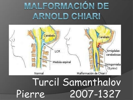 Malformación de arnold chiari
