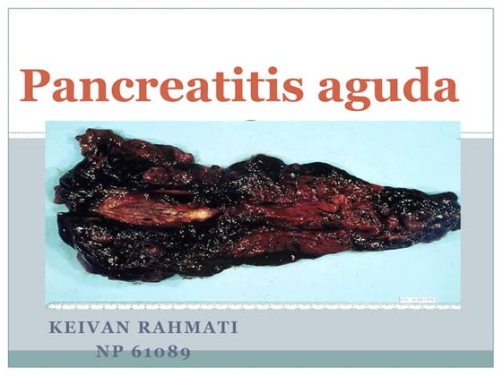Pancreatitis aguda