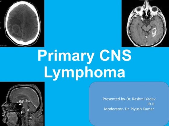 Primary CNS Lymphoma 