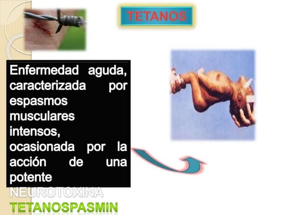 TETANO 