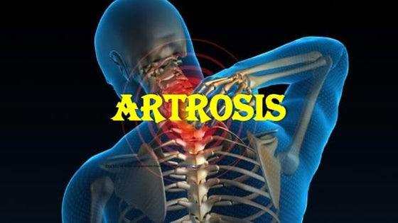 TRABAJO DE ARTROSIS V CICLO GRUPO 1.pptx