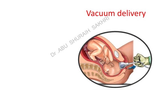 Vacuum delivery