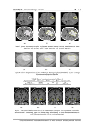 TELKOMNIKA Telecommun Comput El Control 
Adaptive segmentation algorithm based on level set model in medical imaging (Boualem Mansouri)
1135
(a) (b) (c)
Figure 3. Results of segmentation using level set and proposed approach: (a) the input images; (b) image
segmented with level set; and (c) image segmented with proposed approach
(a) (b) (c)
Figure 4. Results of segmentation: (a) the input image; (b) image segmented with level set; and (c) image
segmented with proposed approach
Table1. Data of experiments presented in Figure 4
Segmentation methods Initial contour Iteration Cost Time Segmentation state
Level set Internal − 680 90 s Not
Proposed approach Internal 178 − 17 s Achieved
(a) (b) (c) (d)
Figure 5. The results of the segmentation of the hippocampus correspond to a subject with Alzheimer’s
(advanced stage): (a) the input image; (b) manual image segmentation; (c) image segmented with lev set;
and (d) image segmented with our proposed approach
 