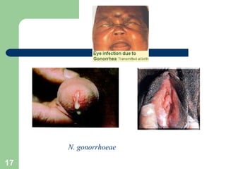 N. gonorrhoeae 