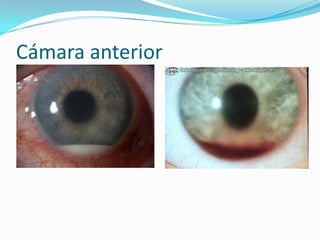 Cámara anterior
 