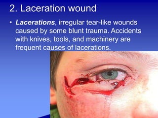 2. Laceration wound
• Lacerations, irregular tear-like wounds
caused by some blunt trauma. Accidents
with knives, tools, and machinery are
frequent causes of lacerations.
 