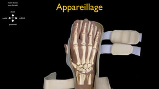 Appareillage
         main droite
         vue dorsale


           distal


radial                 cubital


          proximal
 