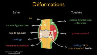 Déformations
            Saine                                      Touchée
                                 os
                                                     capsule ligamentaire
                                                         enﬂammée
 capsule ligamentaire

      liquide synovial                                 pannus synovial

            cartilage

 membrane synoviale                                     cartilage et os
                                                     sous-chondral érodés
articulation interphalangienne
     coupe longitudinale
 