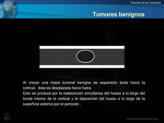 Tumores benignos Al crecer una masa tumoral benigna de expansión lenta hacia la cortical,  ésta es desplazada hacia fuera.  Esto se produce por la reabsorción simultánea del hueso a lo largo del borde interior de la cortical  y  la deposición del hueso a lo largo de la superficie externa por el periostio .  