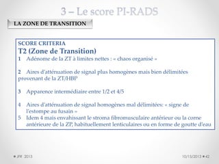 LA ZONE DE TRANSITION

SCORE CRITERIA

T2 (Zone de Transition)
1 Adénome de la ZT à limites nettes : « chaos organisé »
2 Aires d’atténuation de signal plus homogènes mais bien délimitées
provenant de la ZT/HBP
3

Apparence intermédiaire entre 1/2 et 4/5

4

Aires d’atténuation de signal homogènes mal délimitées: « signe de
l’estompe au fusain »
Idem 4 mais envahissant le stroma fibromusculaire antérieur ou la corne
antérieure de la ZP, habituellement lenticulaires ou en forme de goutte d’eau

5

JFR 2013

10/15/2013

42

 
