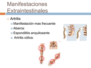 Manifestaciones ExtraintestinalesArtritisManifestación mas frecuenteAbarca:Espondilitis anquilosante Artritis cólica.