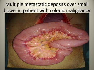 Multiple metastatic deposits over small
bowel in patient with colonic malignancy
 