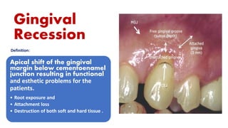 Gingival
Recession
Definition:
Apical shift of the gingival
margin below cementoenamel
junction resulting in functional
and esthetic problems for the
patients.
• Root exposure and
• Attachment loss
• Destruction of both soft and hard tissue .
 