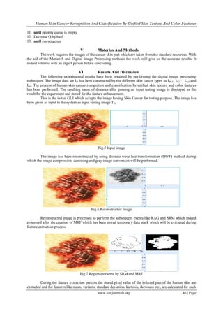 Human Skin Cancer Recognition And Classification By Unified Skin Texture And Color Features
www.iosrjournals.org 46 | Page
11. until priority queue is empty
12. Decrease Q by half
13. until convergence
V. Materias And Methods
The work requires the images of the cancer skin part which are taken from the standard resources. With
the aid of the Matlab-8 and Digital Image Processing methods the work will give us the accurate results. It
indeed referred with an expert person before concluding.
VI. Results And Discussion
The following experimental results have been obtained by performing the digital image processing
techniques. The image data set ID has been constructed by the different skin cancer types as IBCC, ISCC , Imel and
Iact. The process of human skin cancer recognition and classification by unified skin texture and color features
has been performed. The resulting name of diseases after passing an input testing image is displayed as the
result for the experiment and stored for the feature enhancement.
This is the initial GUI which accepts the image having Skin Cancer for testing purpose. The image has
been given as input to the system as input testing image TD.
Fig.5 Input image
The image has been reconstructed by using discrete wave late transformation (DWT) method during
which the image compression, denoising and gray image conversion will be performed.
Fig.6 Reconstructed Image
Reconstructed image is processed to perform the subsequent events like RAG and SRM which indeed
processed after the creation of MRF which has been stored temporary data stack which will be extracted during
feature extraction process
Fig.7 Region extracted by SRM and MRF
During the feature extraction process the stored pixel value of the infected part of the human skin are
extracted and the features like mean, variants, standard deviation, kurtosis, skewness etc., are calculated for each
 