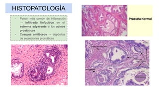 HISTOPATOLOGÍA
- Patrón más común de inflamación
→ infiltrado linfocítico en el
estroma adyacente a los acinos
prostáticos
- Cuerpos amiláceos → depósitos
de secreciones prostáticas
 
