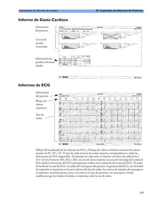 Impresiones de informes de muestra                                     24 Impresión de Informes de Paciente


Informe de Gasto Cardíaco
              Información
              del paciente


              Curvas de
              prueba
              numeradas



              Información de
              prueba en formato
              tabular




Informes de ECG
              Información
              del paciente
              Bloque de
              valores
              numéricos

              Área de
              ondas




              Debajo del encabezado de los informes de ECG, el bloque de valores numéricos muestra los valores
              actuales de FC, EV y ST. El área de onda muestra las ondas impresas correspondientes a todas las
              derivaciones de ECG disponibles. Al principio de cada onda se imprime una barra de calibración 1
              mV. Con los formatos 3X4, 6X2 y 2X4, una tira de ritmo imprime una sección más larga de la onda de
              ECG desde la derivación del ECG principal para realizar una evaluación del ritmo del ECG. El ancho
              de banda de la señal de ECG, el estado del marcapasos del paciente, la ganancia del ECG y la velocidad
              de impresión se imprimen en la parte inferior del área de ondas. Las marcas de impulsos de marcapasos
              se imprimen automáticamente junto a la onda en el caso de pacientes con marcapasos. Puede
              establecerse que los rótulos de latidos se impriman sobre la tira de ritmo.




                                                                                                                253
 