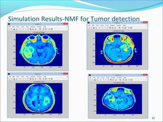 Simulation Results-NMF for Tumor detection
45
 