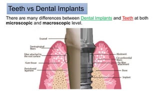 Teeth vs Dental Implants
There are many differences between Dental Implants and Teeth at both
microscopic and macroscopic level.
 