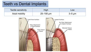 Teeth vs Dental Implants
Low
High
Tactile sensitivity
3–5 μm
25–100 μm
Axial mobility
 