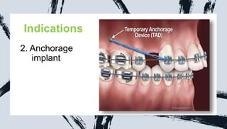Indications
2. Anchorage
xc implant
 