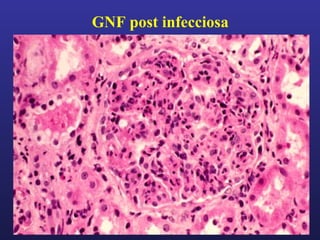 GNF post infecciosa

 
